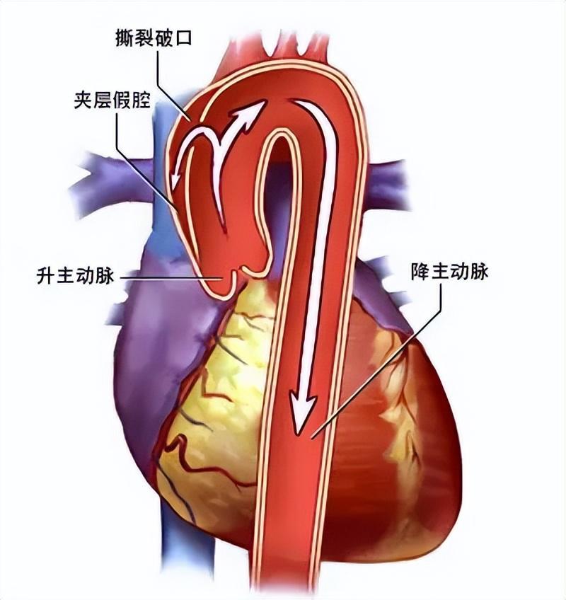 高血压最新定义,高血压的新标准