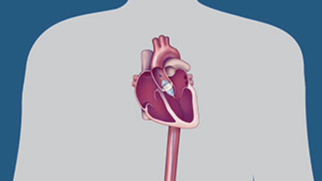 心脏瓣膜置换新技术，重塑生命动力之源